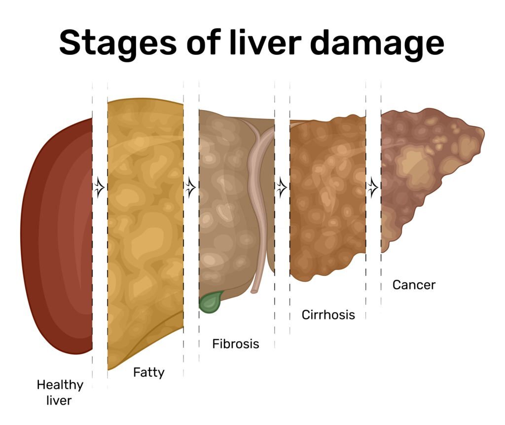 What are the stages of liver disease until Cirrhosis