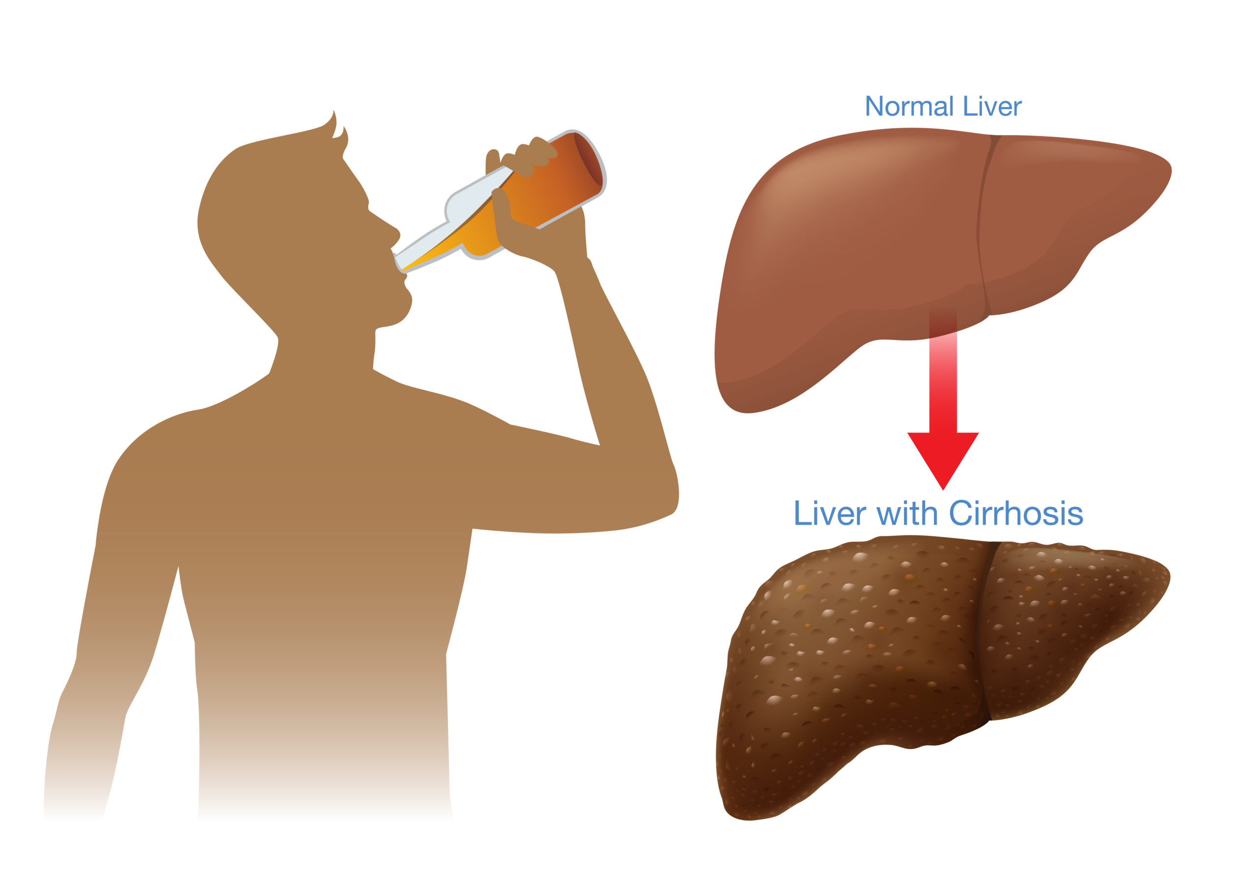 An Overview of Alcoholic Liver Disease